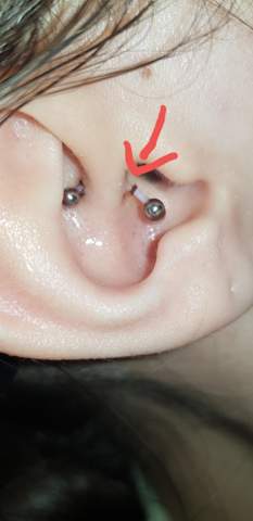 Wie Entferne Ich Diese Kruste Am Daith Piercing Blut Piercingschmuck