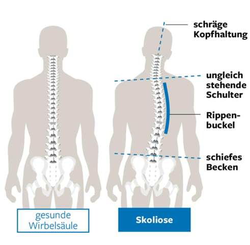 Wie entsteht ein (einseitiger) Rippenbuckel? (Wirbelsäule, Skoliose)