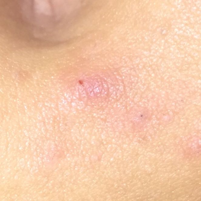 pickel am bauch ursache pickel am bauch ursache