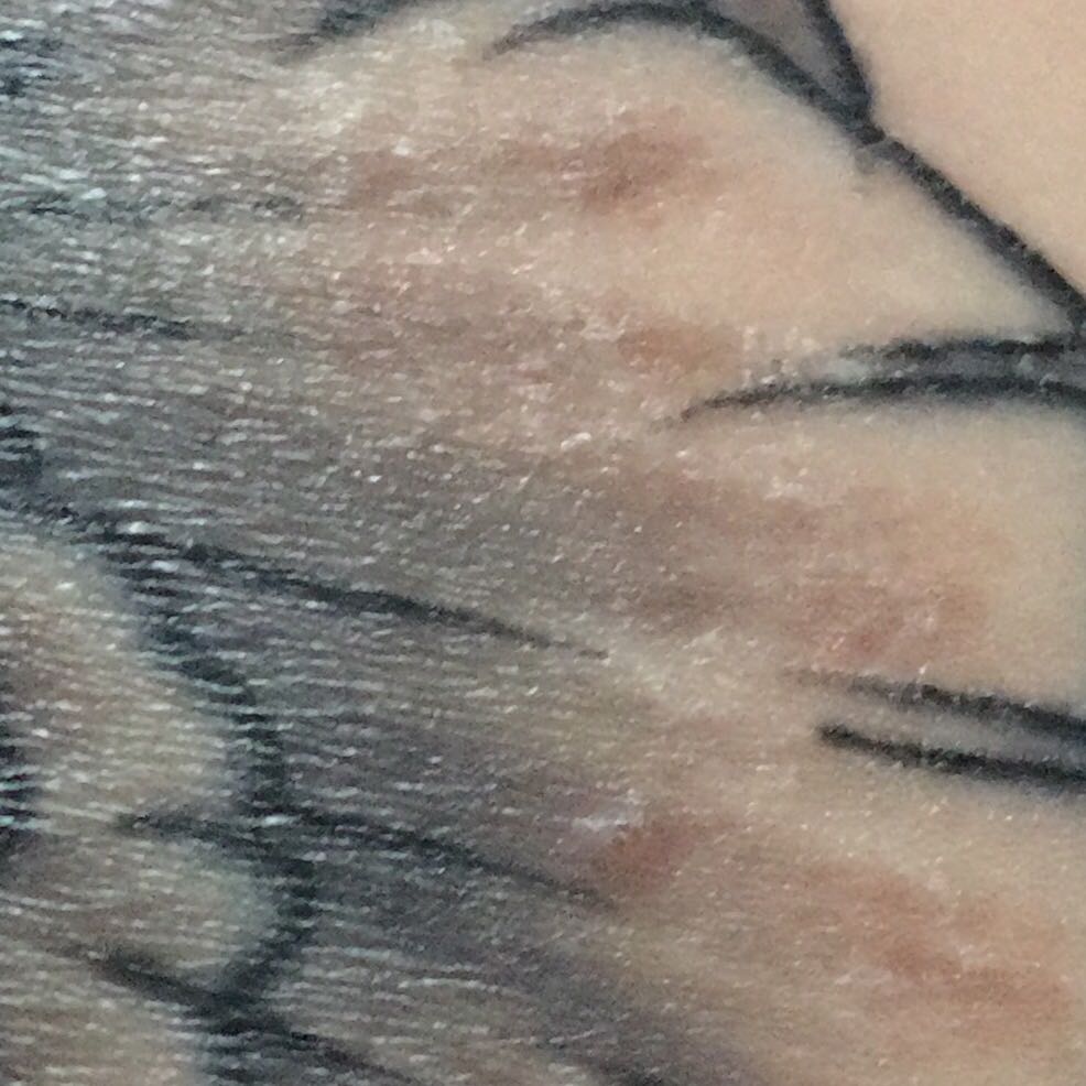 Wie erkennt man eine Entzündung am Tattoo?
