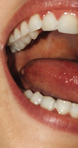 Wie erkennt man zungenkrebs? (Gesundheit und Medizin, Gesundheit, Medizin)