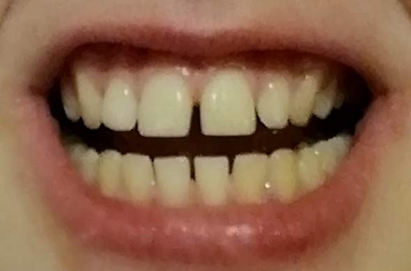 Wie findet ihr solche Zähne?