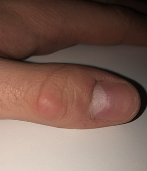 Was Kann Ich Tun Damit Wunden An Den Fingern Schnell Heilen Gesundheit Und Medizin Gesundheit Hausmittel Was Kann Ich Tun Damit Wunden An Den Fingern Schnell Heilen Gesundheit Und Medizin Gesundheit Hausmittel