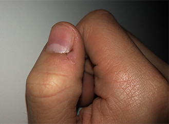 Was Kann Ich Tun Damit Wunden An Den Fingern Schnell Heilen Gesundheit Und Medizin Gesundheit Hausmittel Was Kann Ich Tun Damit Wunden An Den Fingern Schnell Heilen Gesundheit Und Medizin Gesundheit Hausmittel