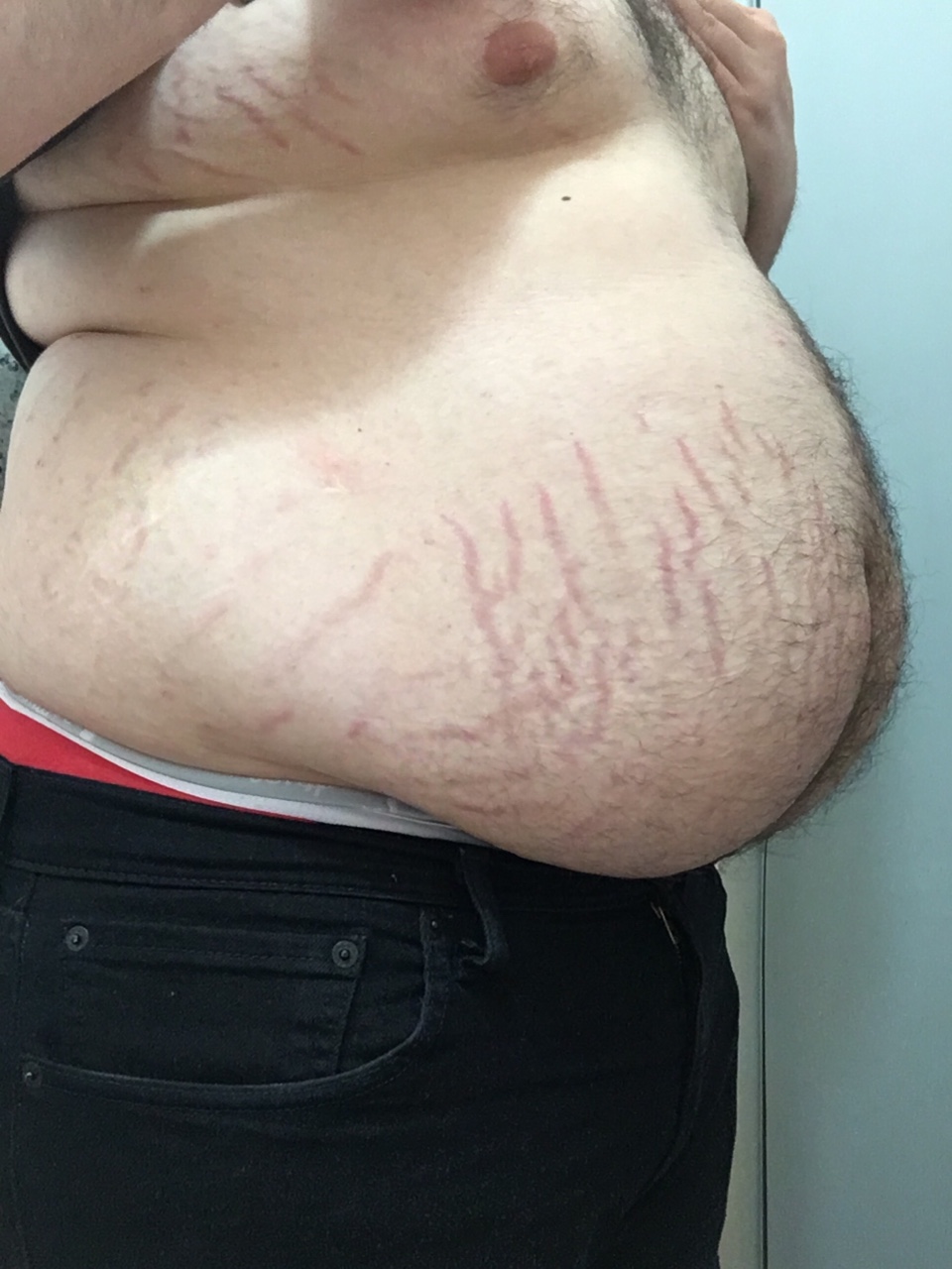 Wie gehen starke Dehnungsstreifen am Bauch weg (Mann)? (Gesundheit)