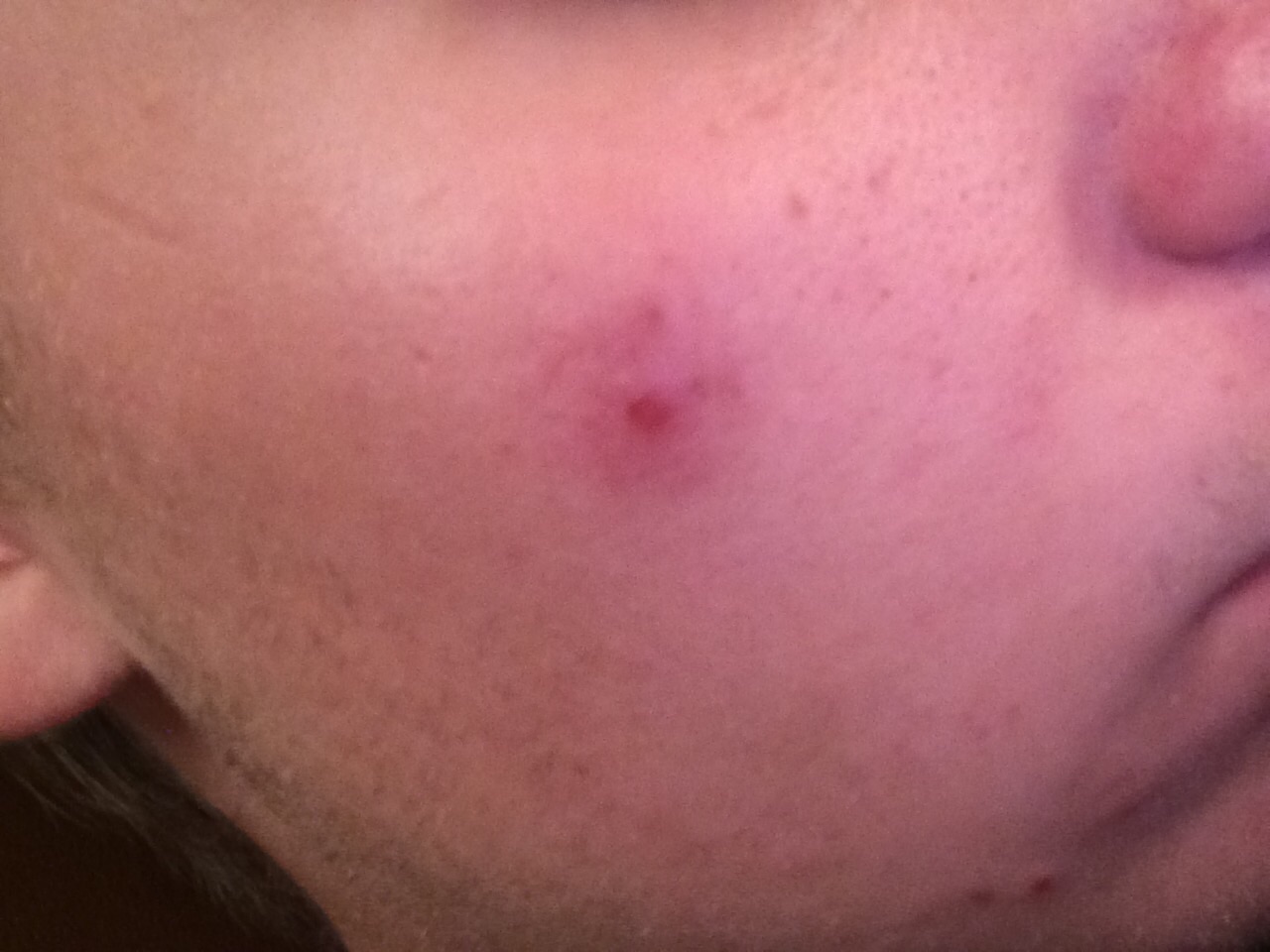 50 Pickel Auf Innerer Schamlippe 2021 Photos 50 Pickel Auf Innerer Schamlippe 2021 Photos