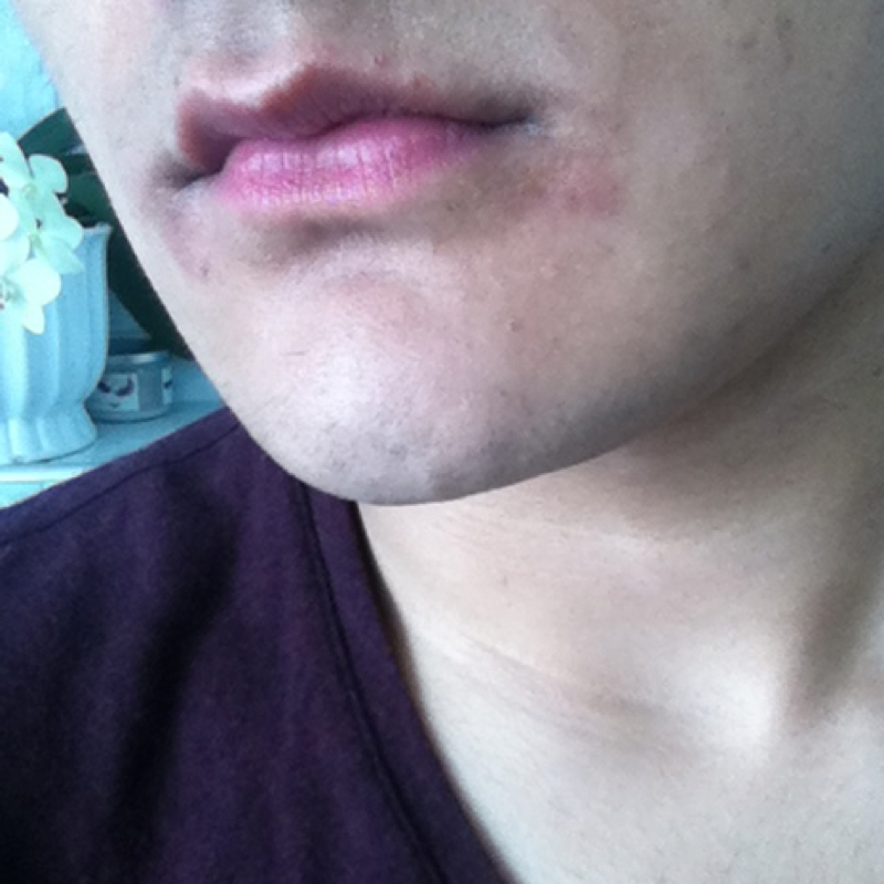 Get Pickel Unter Der Haut Geht Nicht Weg Gif