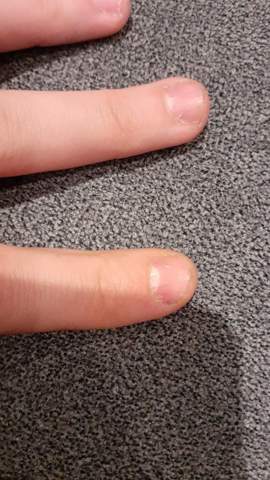 Wie höre ich auf meine Fingernägel zu knabbern?