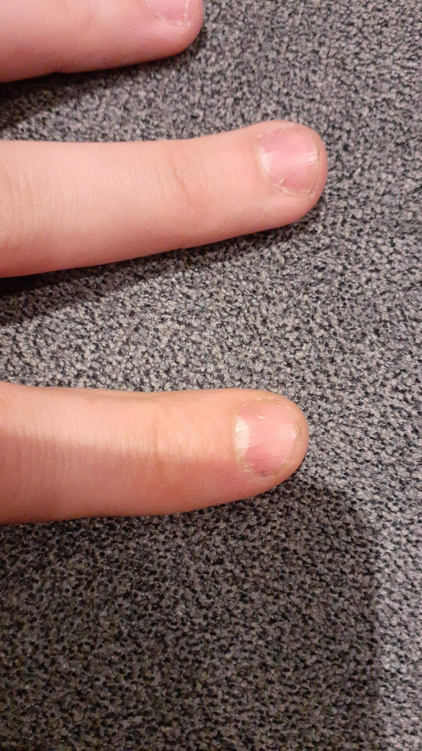 Wie höre ich auf meine Fingernägel zu knabbern? (Frauen, Körper, Haut)
