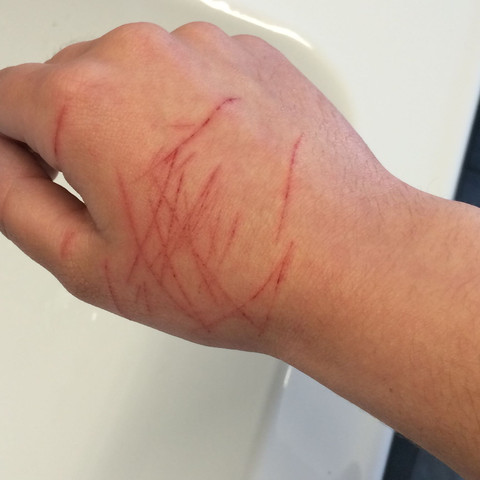 Wie Kann Die Wunde Schneller Heilen Hand Wie Kann Die Wunde Schneller Heilen Hand