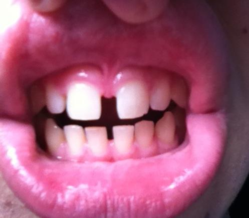 Zwischen den zahnlücke schneidezähnen grosse Zahnlücke zwischen