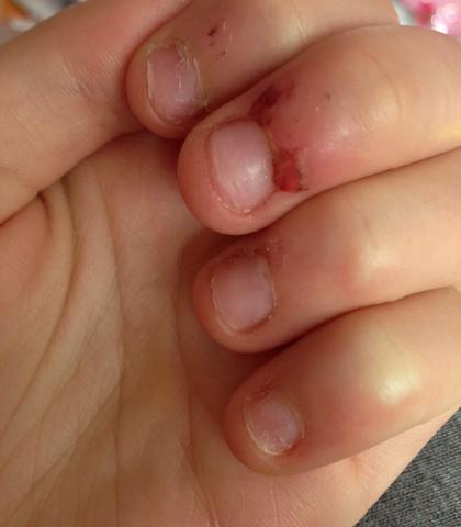 Wie Kann Ich Es Mir Abgewohnen Haut Fingernagel Fingernagel Kauen