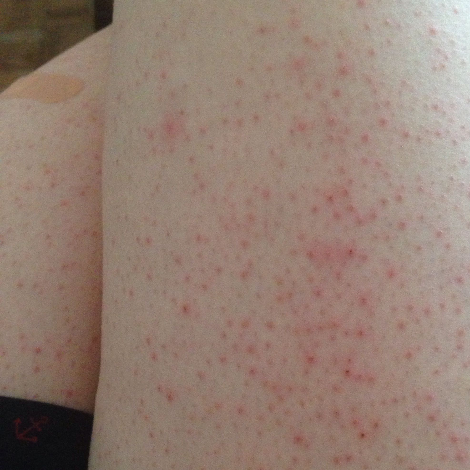 29+ Rote Flecken Nach Pickel Wie Lange Pictures