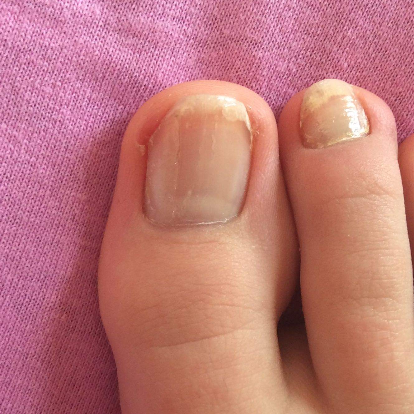 Wie Bekomme Ich Nagelkleber Vom Nagel