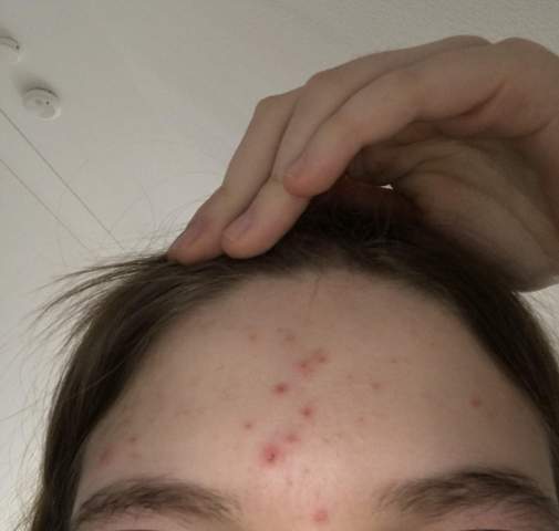 Wie Kann Ich Meine Pickel Loswerden Gesundheit Und Medizin Madchen Beauty Wie Kann Ich Meine Pickel Loswerden Gesundheit Und Medizin Madchen Beauty