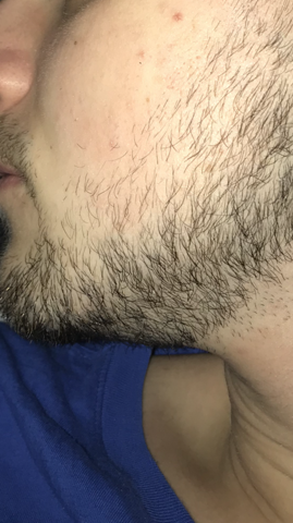 Wie Kann Ich Meinen Bart Dichter Bekommen Haare Bartwuchs