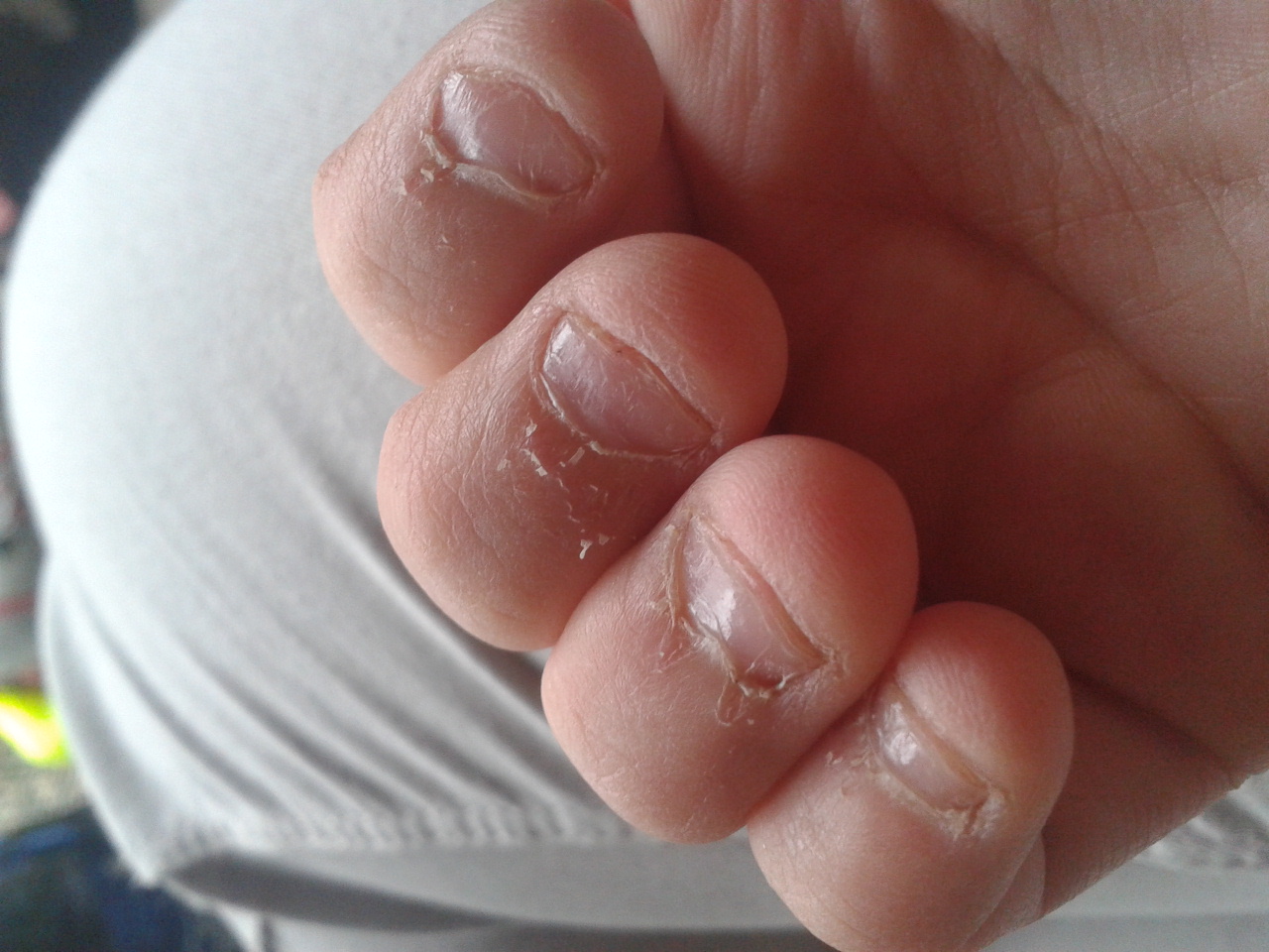 Wie kann ich Nägelkauen aufhören? Hilfe!