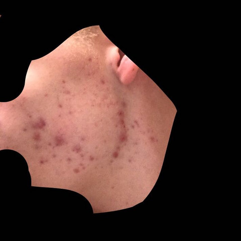 Wie Kann Ich Plotzliche Pickel Wegbekommen Gesundheit Und Medizin Akne