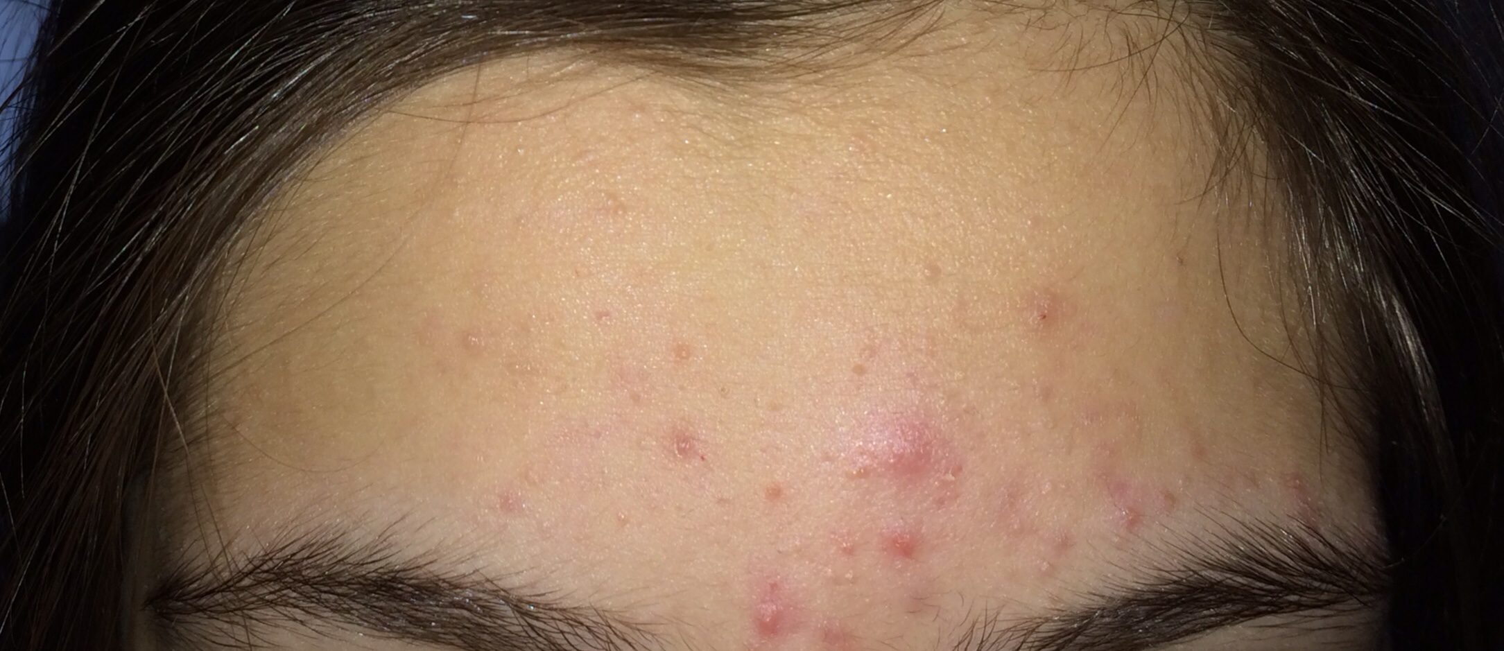 Wie Kann Ich Solche Pickel Loswerden Gesundheit Beauty Stirn