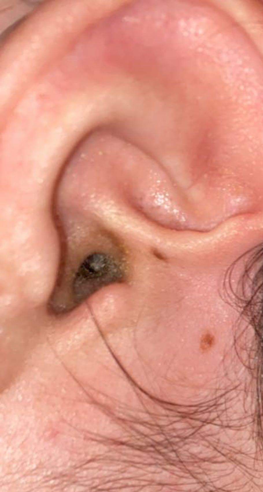 Wie kann man seinen Ohrenschmalz entfernen? (Gesundheit und Medizin, Ohr)