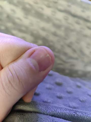 Wie Kann Mein Eingerissener Nagel Wieder Normal Rauswachsen Nagel Fingernagel