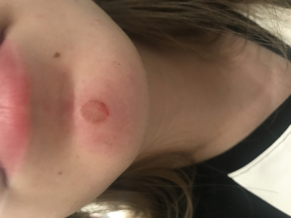 Wie Kann Meine Brandblase Schnell Heilen Wie Kann Meine Brandblase Schnell Heilen
