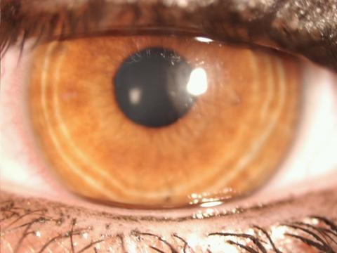 Wie Kommen Die Ringe In Die Iris Augen Optik Wie Kommen Die Ringe In Die Iris Augen Optik