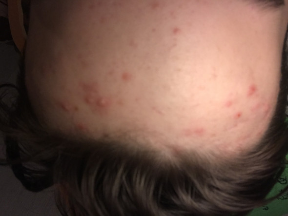 Wie Kriege Ich Die Pickel An Meiner Stirn Weg Aktive Methoden Haut Wie Kriege Ich Die Pickel An Meiner Stirn Weg Aktive Methoden Haut