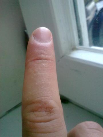 Mein Finger - (Arzt, Krankheit, Haut)