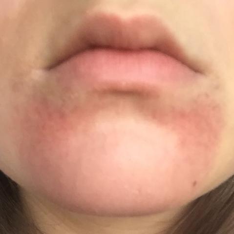 Wie Kriege Ich Diese Flecken Weg Haut Challenge Rote Flecken