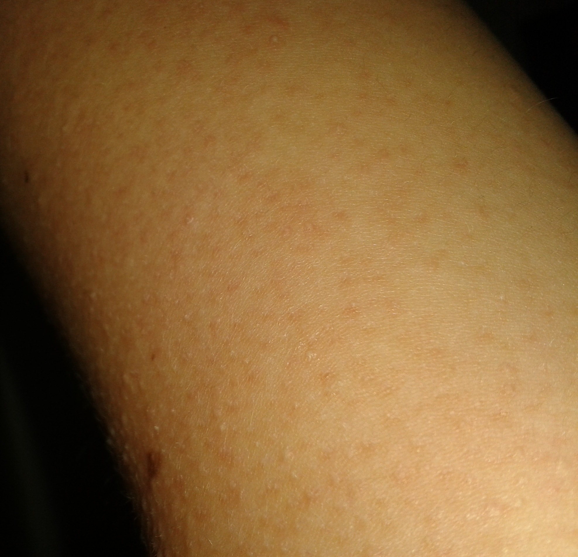 26+ Rote Flecken Nach Pickel Gehen Nicht Weg Images