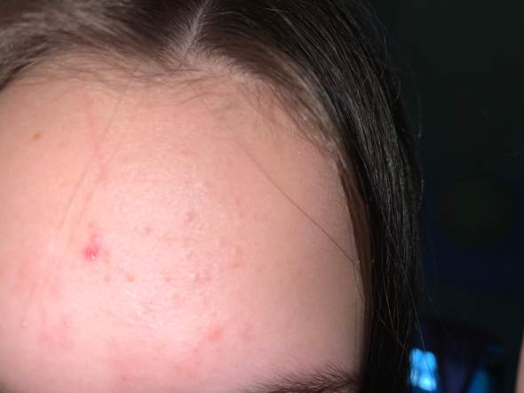 Wie Kriege Ich Diese Nervigen Pickel Weg Gesundheit Und Medizin Wie Kriege Ich Diese Nervigen Pickel Weg Gesundheit Und Medizin