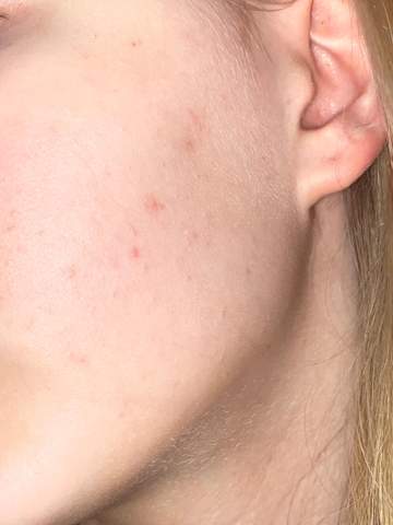 Wie Kriege Ich Diese Pickel Weg Haut Wie Kriege Ich Diese Pickel Weg Haut