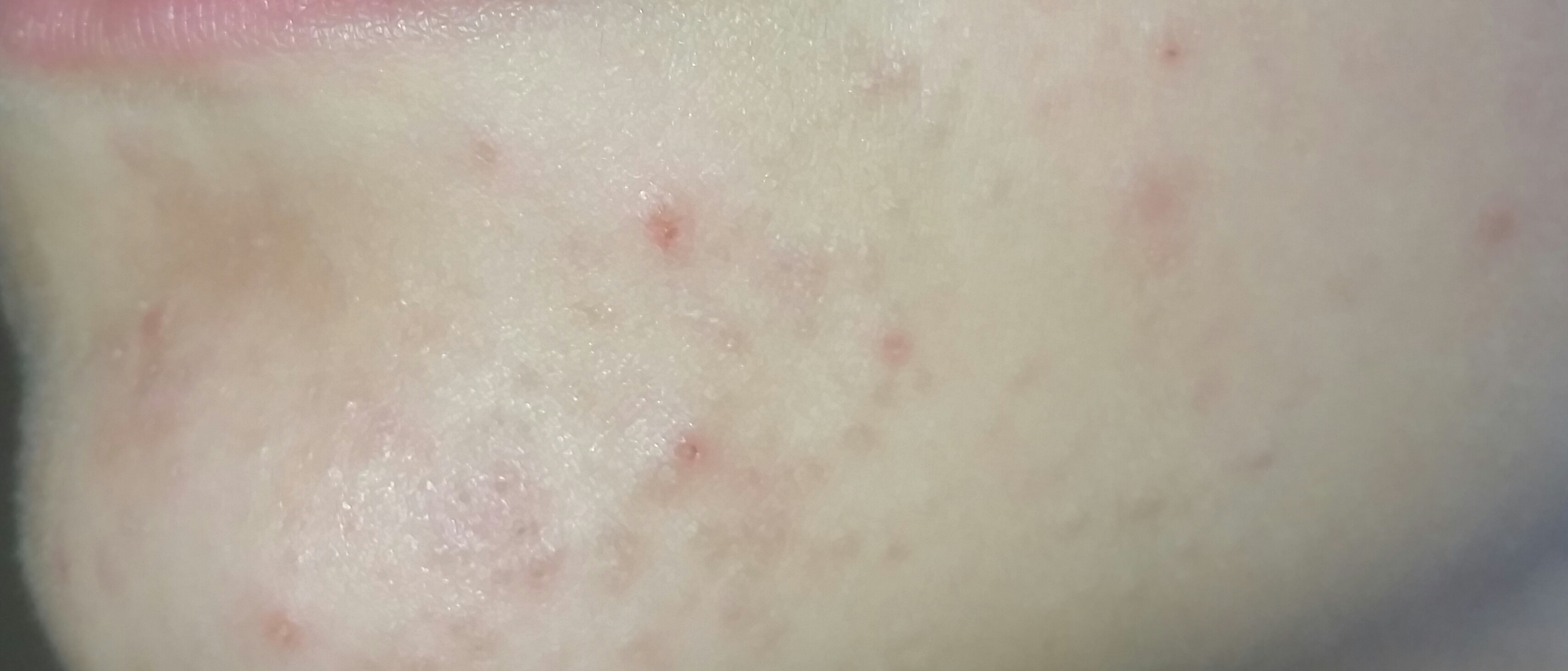 Wie Kriege Ich Meine Zähne Weiß Wie kriege ich meine Acne weg? (Pickel, Akne, Gesichtspflege)