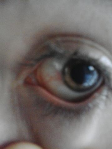 Die Augenrötung - (Chronisch, Augenprobleme, augenentzündung)