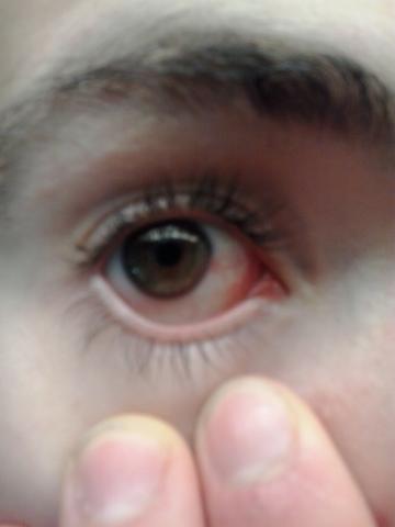 Die Augenrötung - (Chronisch, Augenprobleme, augenentzündung)