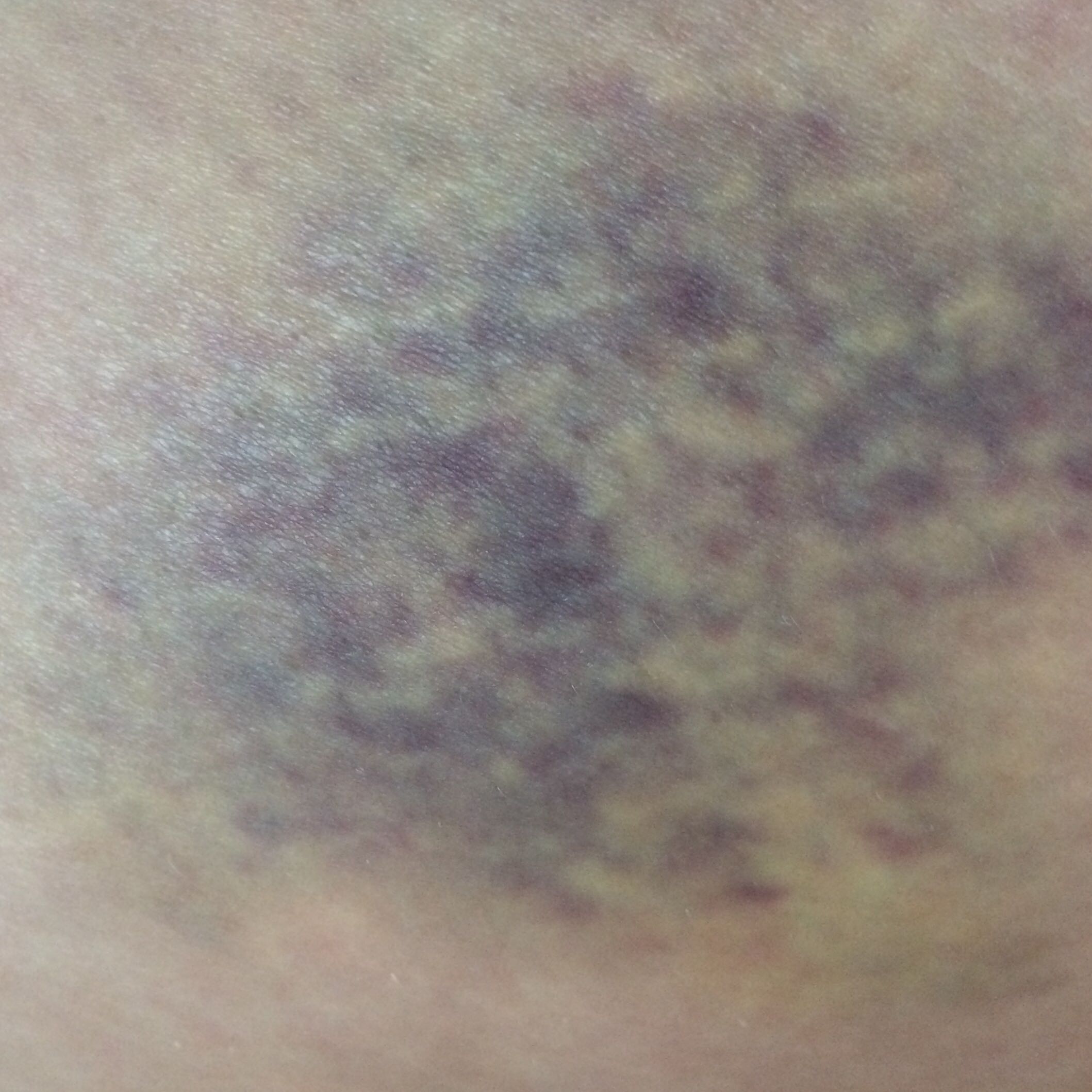 Wie kriege ich schnell diese blauen Flecken weg? (Gesundheit und