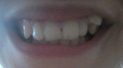 Zähne - (Zähne, Zahnspange)