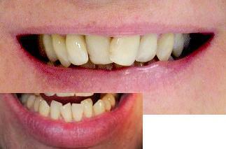 Meine Zahnfehlstellung - (gutefrage.net, Zahnarzt, weiß)