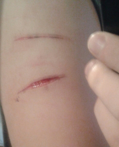 Wie Lange Braucht Diese Wunde Um Zu Verheilen Arzt Heilung Schnitt