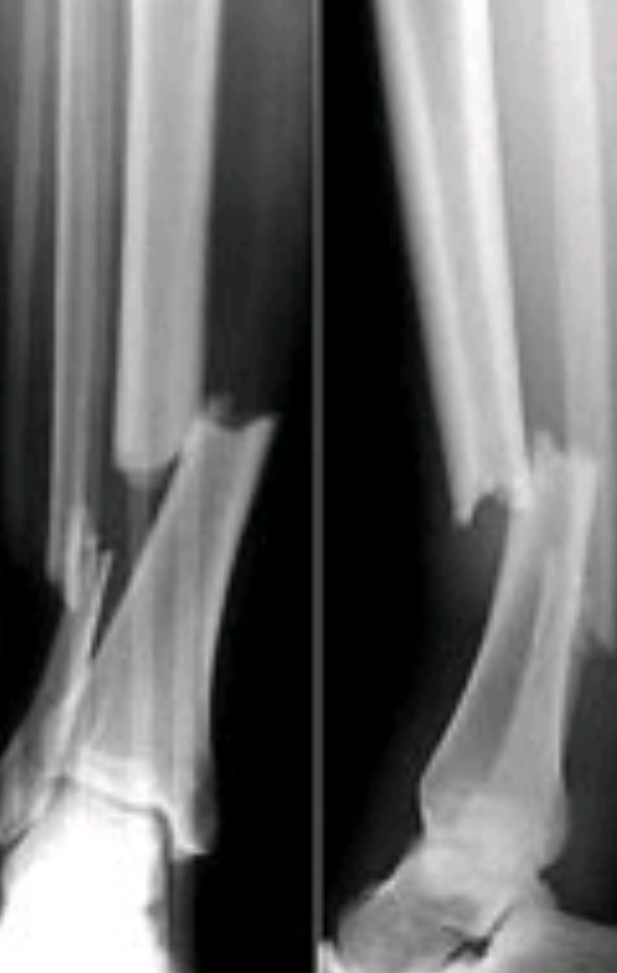 Wie Lange Dauert Es Bis Ein Beckenbruch Verheilt Ist Wie lange braucht ein gebrochenes Bein bis zu vollständigen heilung