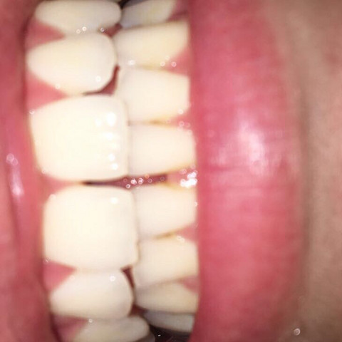 Meine zähne - (Gesundheit und Medizin, Zähne, Kieferorthopäde)