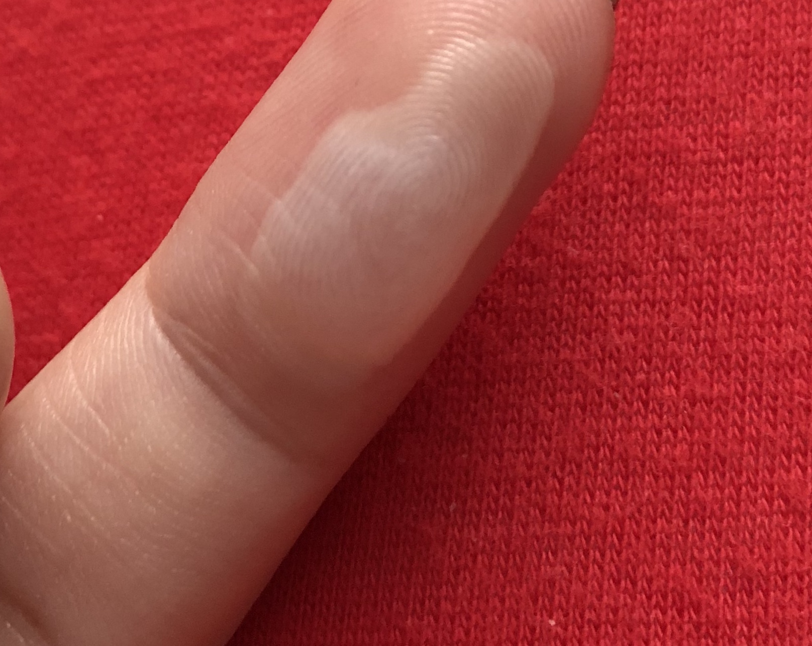 Wie lange dauert die Heilung einer solchen Brandblase? (Gesundheit, Medizin)