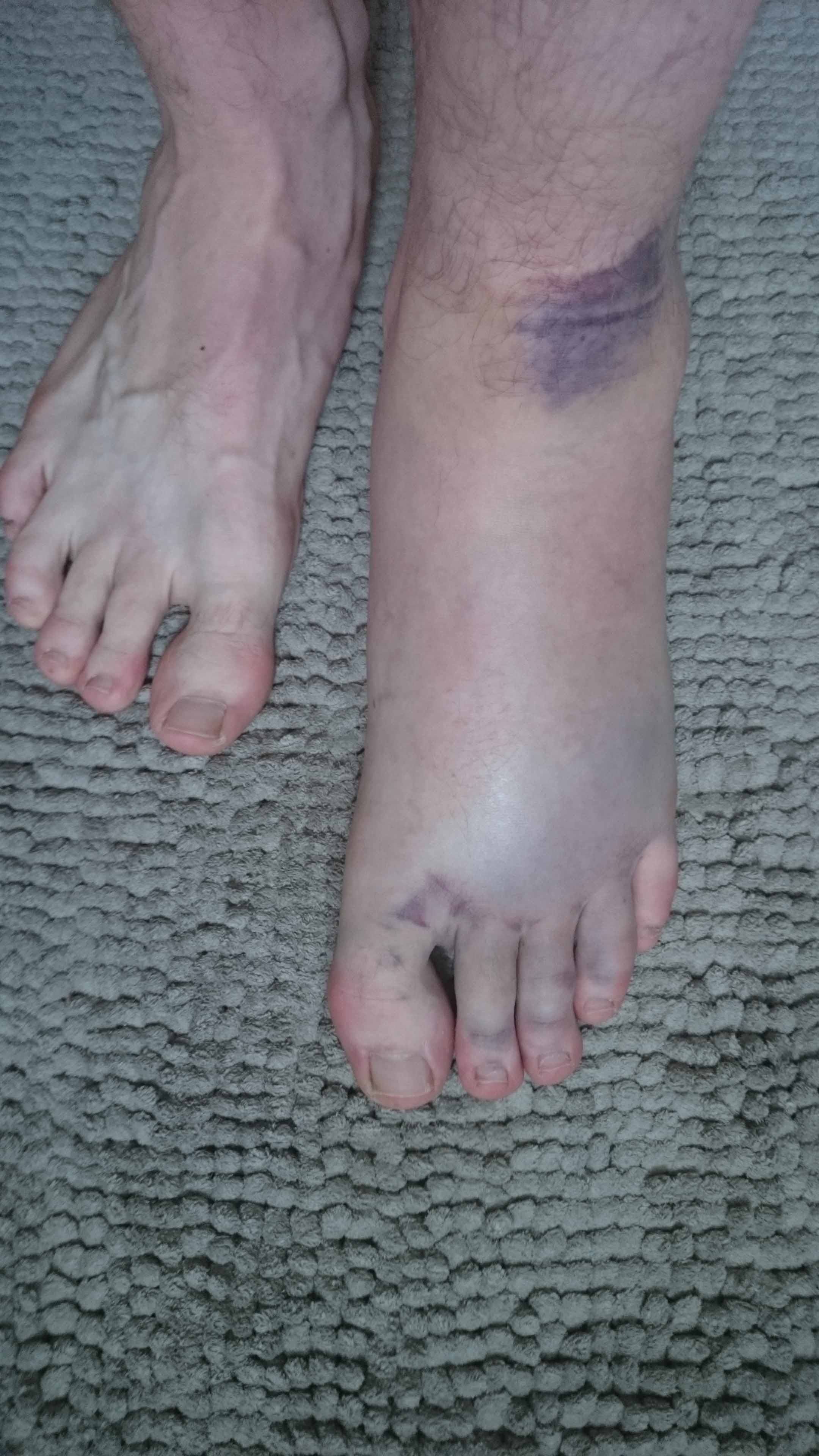Wie Lange Dauert Die Schwellung Bei Einem Banderriss An Sport Medizin Unfall Wie Lange Dauert Die Schwellung Bei Einem Banderriss An Sport Medizin Unfall