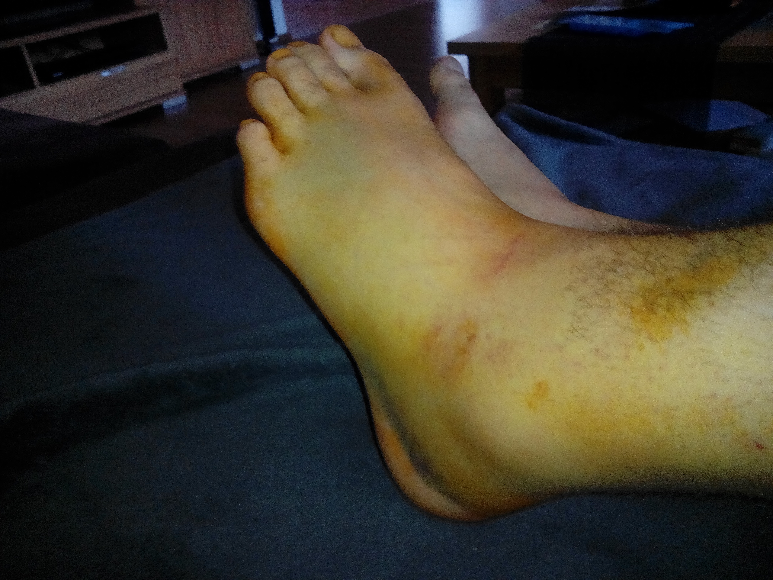 Wie Lange Dauert Die Schwellung Bei Einer Sprunggelenksfraktur Gesundheit Sprunggelenk Banderriss Wie Lange Dauert Die Schwellung Bei Einer Sprunggelenksfraktur Gesundheit Sprunggelenk Banderriss