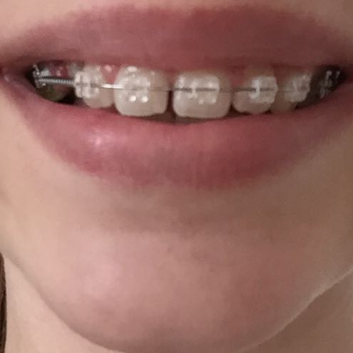 Wie lange dauert es bis die Lücke geschlossen ist? (Zähne, Zahnspange) Wie lange dauert es bis die Lücke geschlossen ist? (Zähne, Zahnspange)