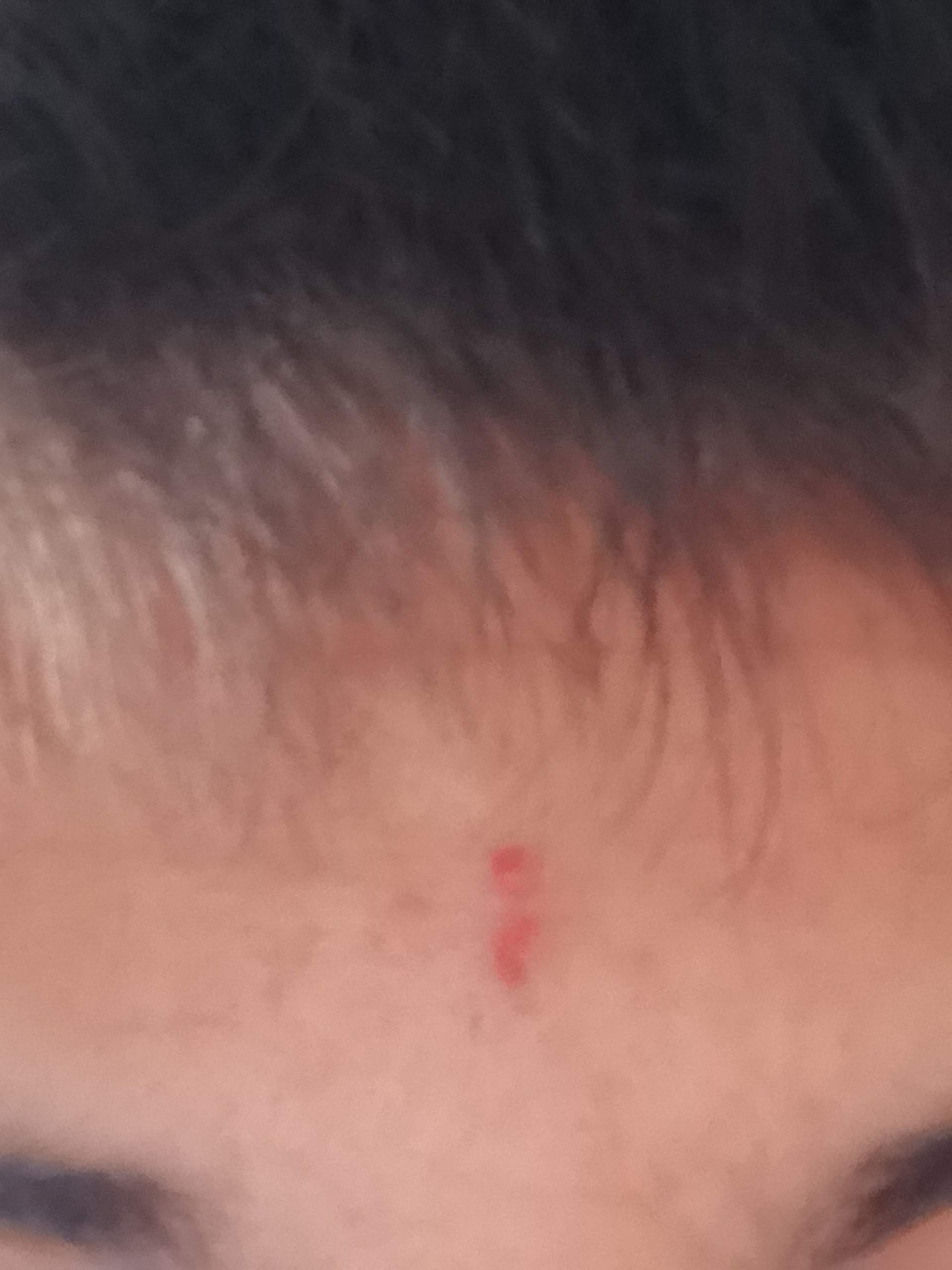 Wie Lange Dauert Es Bis Pickel Von Der Pille Weggehen Wie lange dauert es bis die Wunde von einem Pickel weggeht?