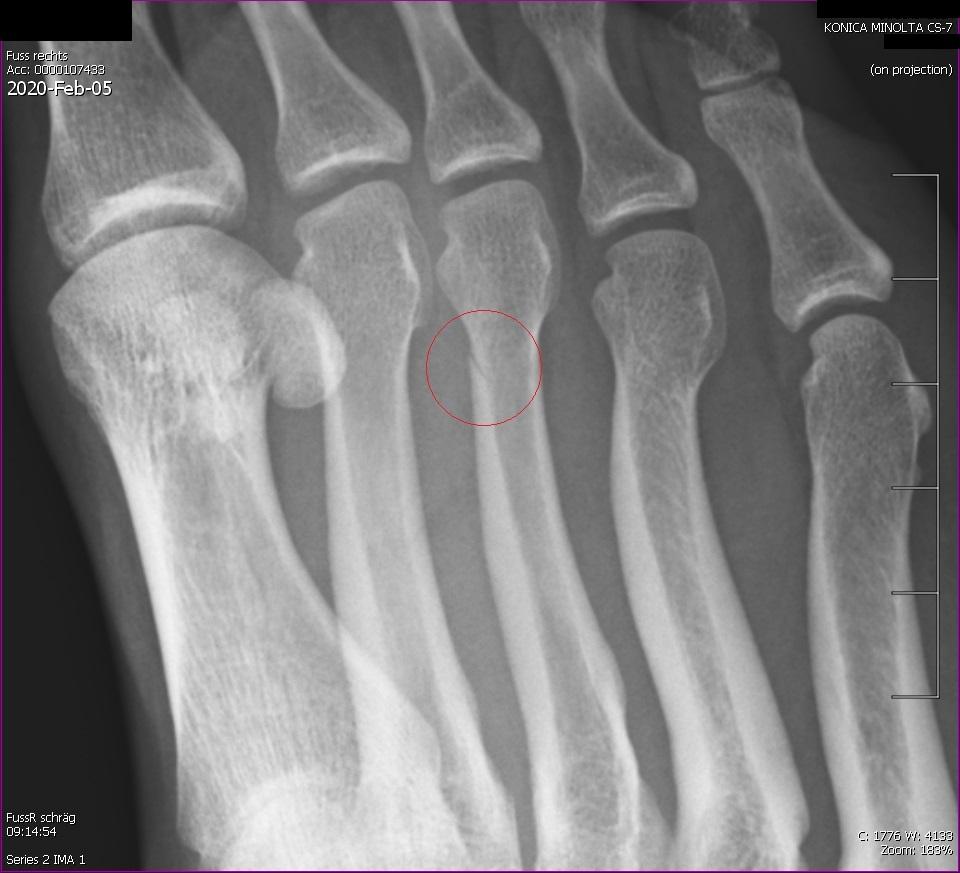 Wie lange dauert es bis ein gebrochener Knochen anfängt zu heilen? (Gesundheit, Medizin) Wie lange dauert es bis ein gebrochener Knochen anfängt zu heilen? (Gesundheit, Medizin)