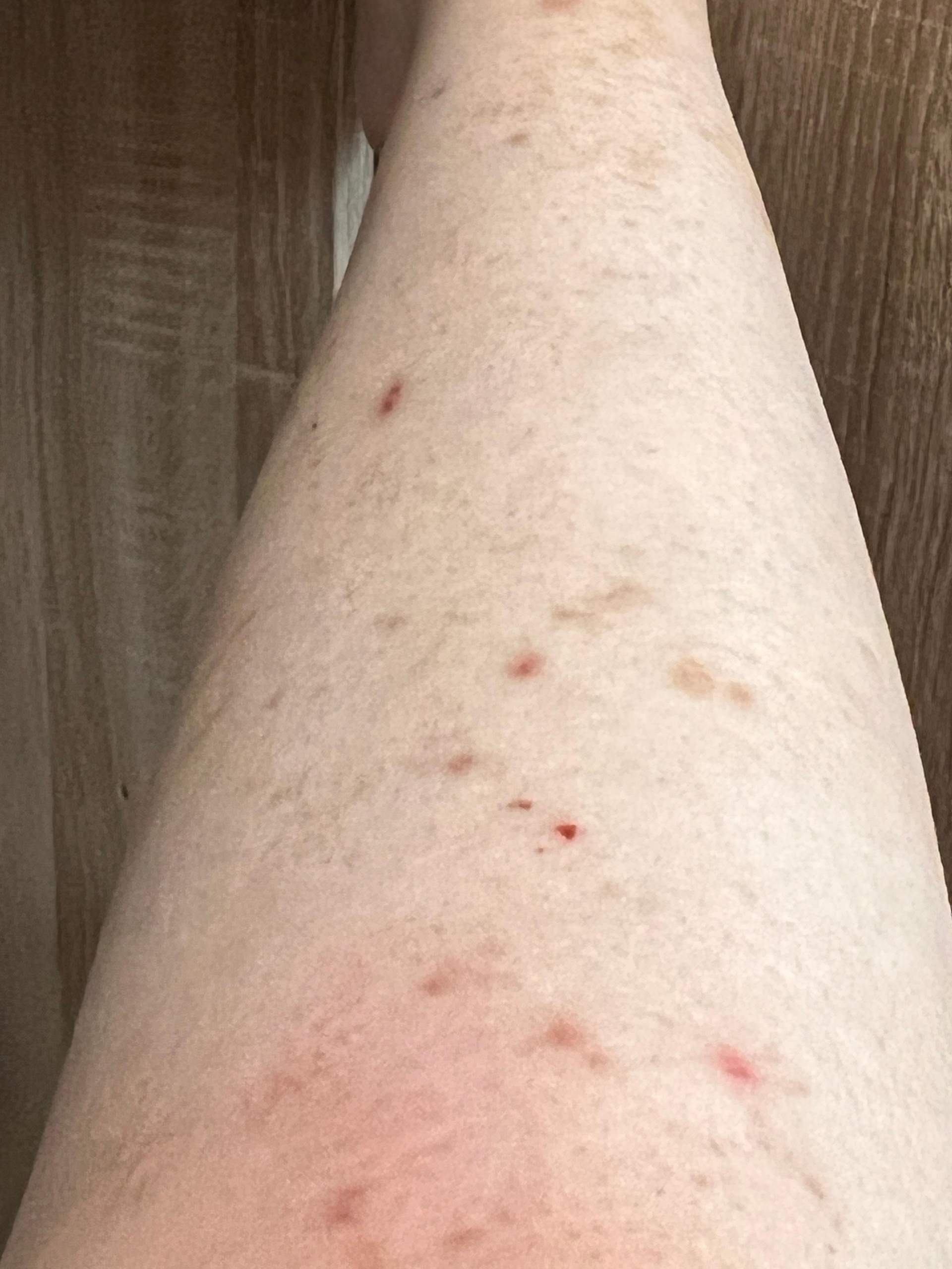 Wie lange dauert es bis es wieder normal aussieht? (Gesundheit und Medizin, Gesundheit, Beine) Wie lange dauert es bis es wieder normal aussieht? (Gesundheit und Medizin, Gesundheit, Beine)