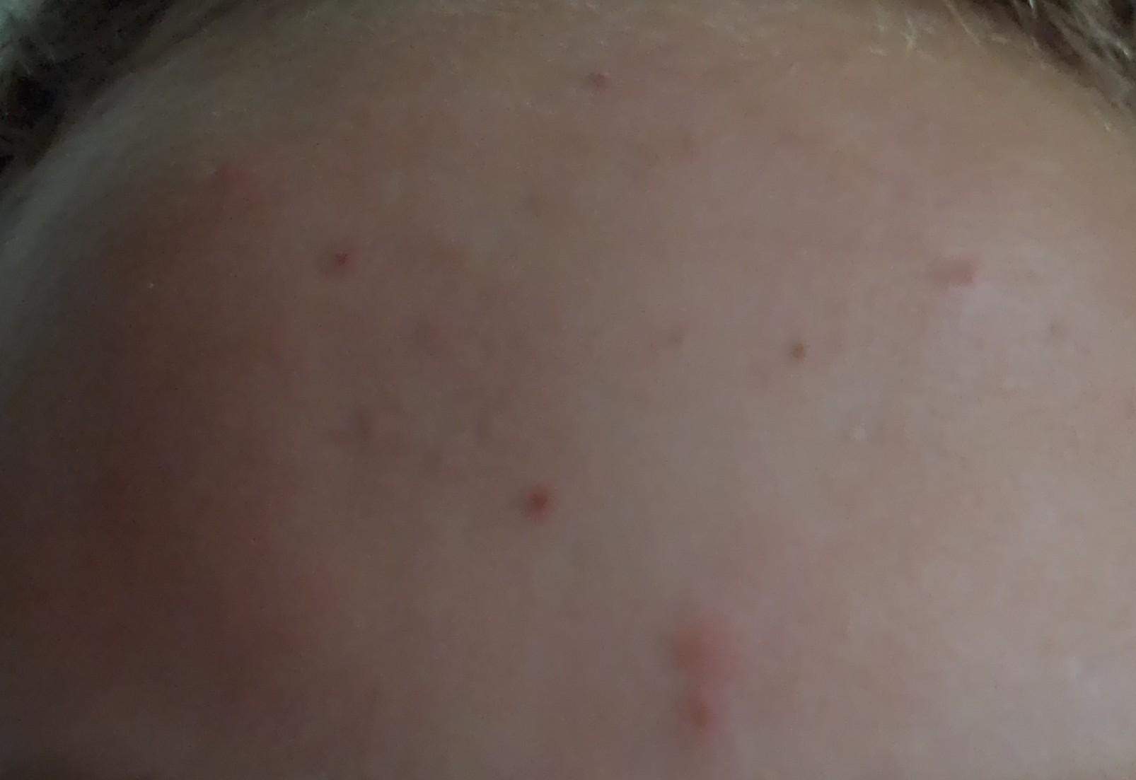 Wie lange dauert es bis meine Pickel weg sind? (Gesundheit und Medizin